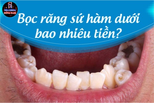 Bọc răng sứ hàm dưới bao nhiêu tiền?