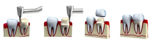 mô phỏng kỹ thuật bọc răng sứ