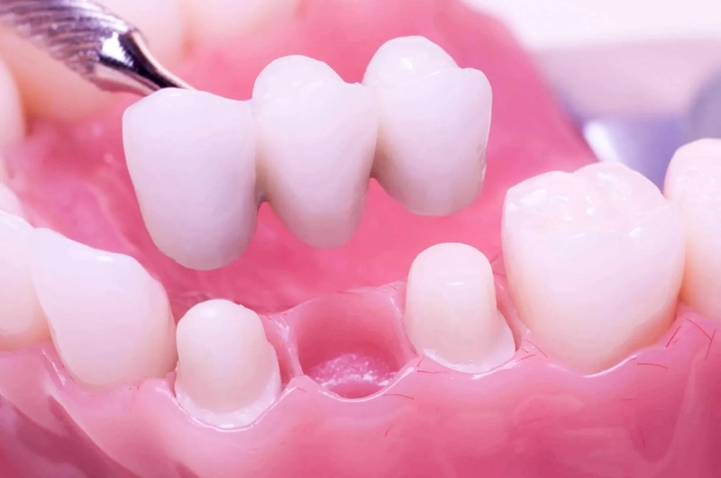 Cầu răng sứ cho răng số 6 mang lại thẩm mỹ cao