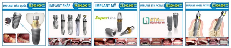 các loại răng implant