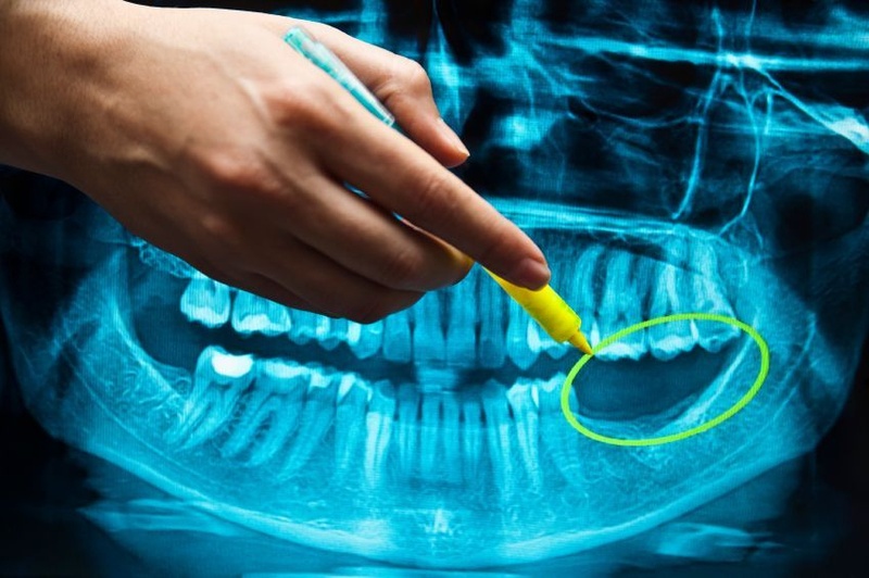 Có nhiều yếu tố ảnh hưởng đến chi phí trồng răng