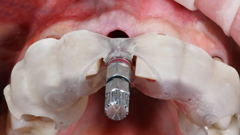 Công nghệ cấy ghép Implant hiện đại giúp rút ngắn quá trình điều trị