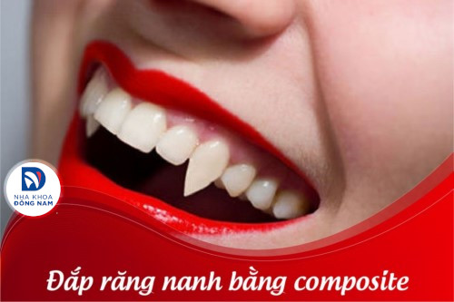 Tư vấn cụ thể: Đắp răng nanh bằng Composite