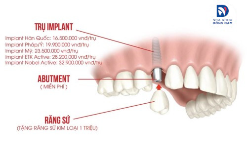 giá răng implant