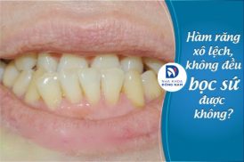 Hàm răng xô lệch, không đều bọc sứ được không?