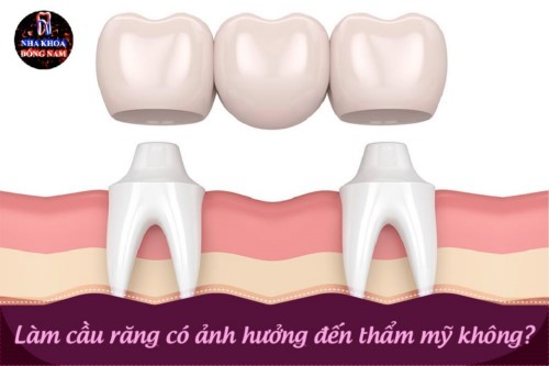 Làm cầu răng có ảnh hưởng đến thẩm mỹ không bác sĩ?