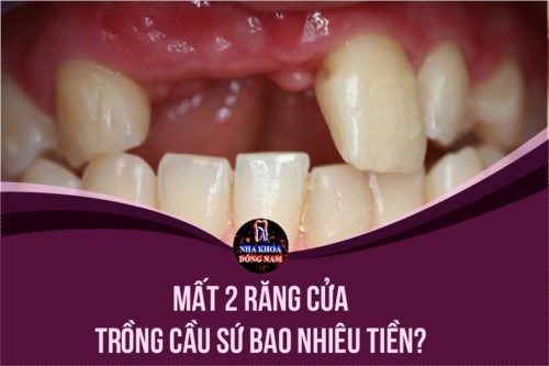 Bị mất 2 răng cửa trồng cầu sứ bao nhiêu tiền?