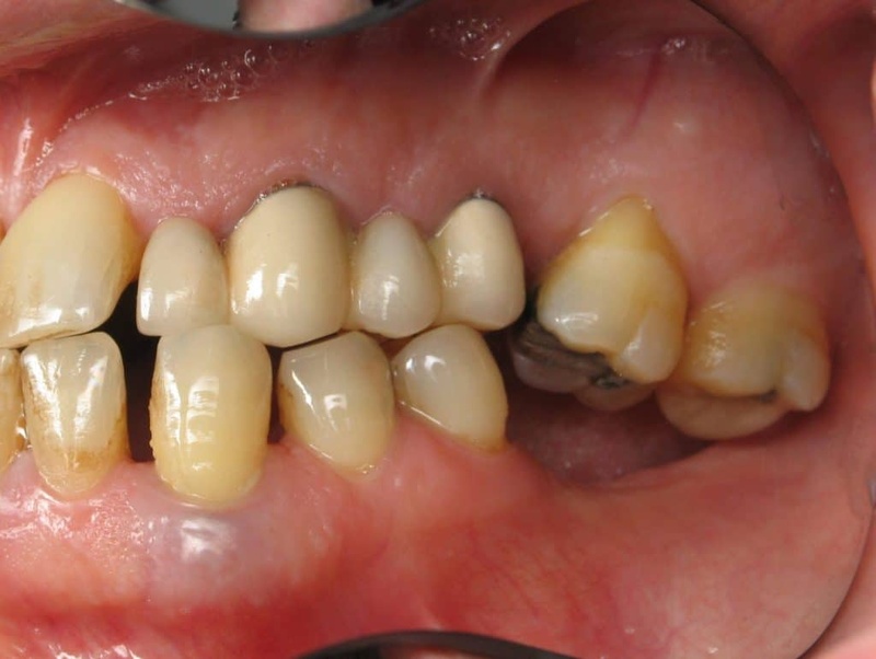 Mất răng số 6 lâu ngày gây tiêu xương hàm