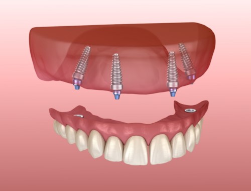 kỹ thuật implant all on 4