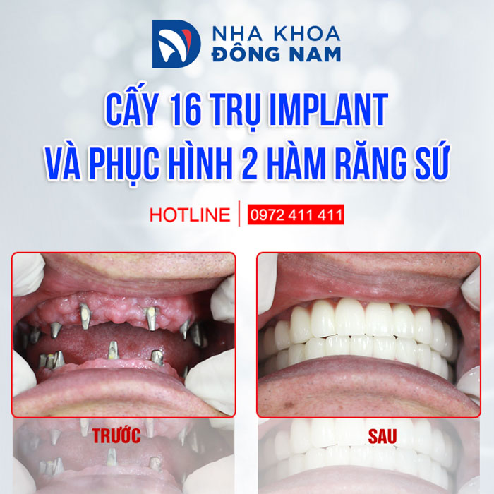 Phục hình răng mất tốt nhất bằng phương pháp cấy ghép Implant