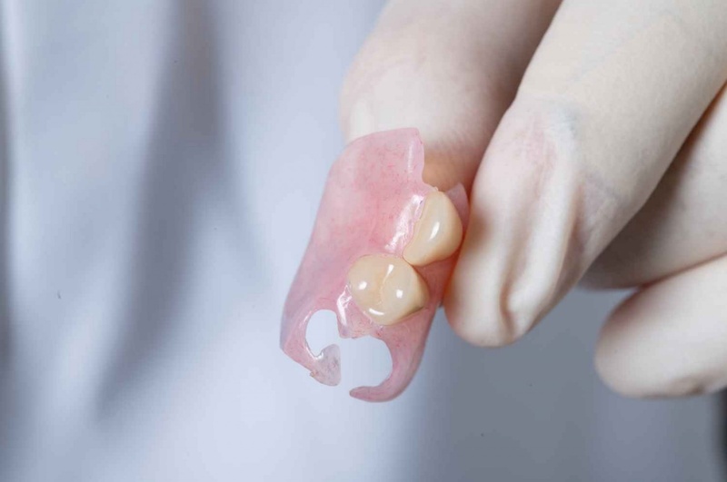 Phục hình răng nanh đã mất bằng răng giả tháo lắp