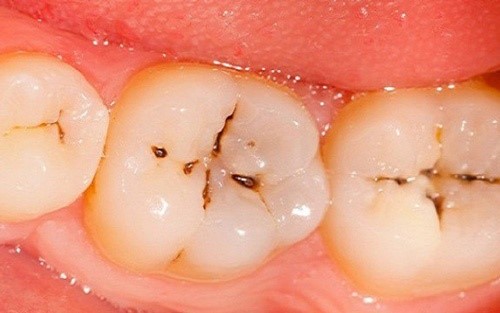 sâu răng