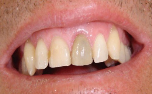 răng bị đen do tủy bị viêm nhiễm