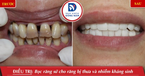 bọc răng sứ cho răng thưa nhiễm màu