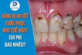 Răng bị hư hết khắc phục như thế nào? Chi phí bao nhiêu?
