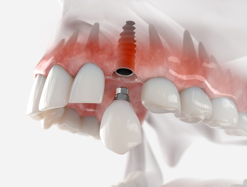 Thời gian hoàn thành tổng thế Implant phụ thuộc nhiều yếu tố
