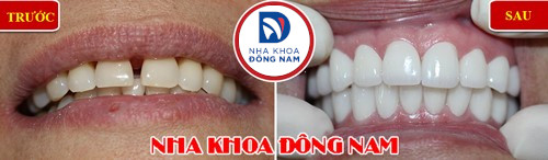 bọc sứ cho răng thưa