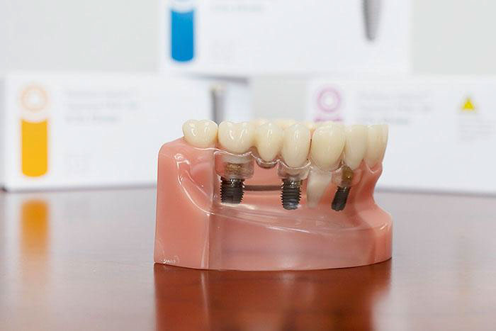 Trồng răng Implant mất bao lâu còn tùy thuộc vào từng giai đoạn điều trị