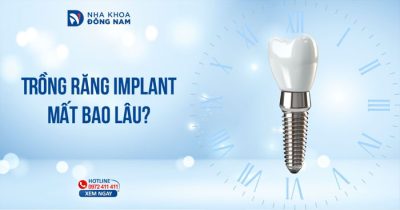 Trồng răng Implant mất bao lâu tại Nha khoa Đông Nam?