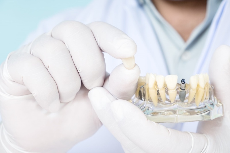 Trồng răng Implant ngay sau khi mất răng
