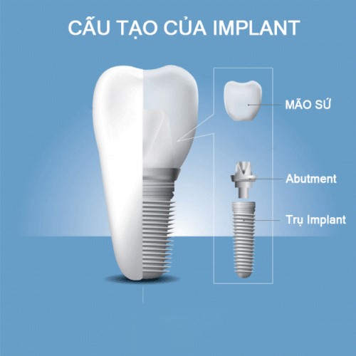 cấu tạo của implant
