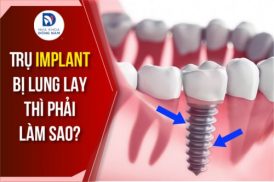 Trụ Implant bị lung lay thì phải làm sao?
