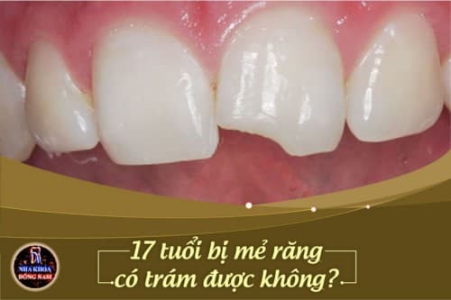 17 tuổi răng bị mẻ có trám được không?