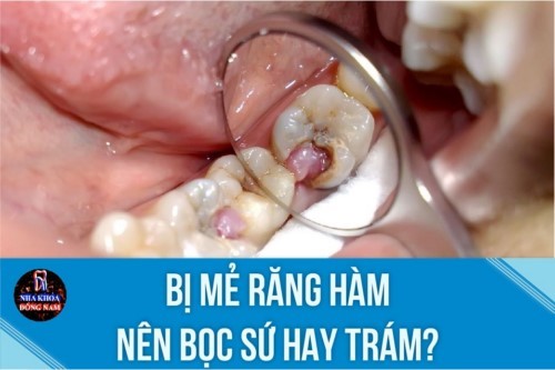 Bị mẻ răng hàm nên bọc sứ hay trám?