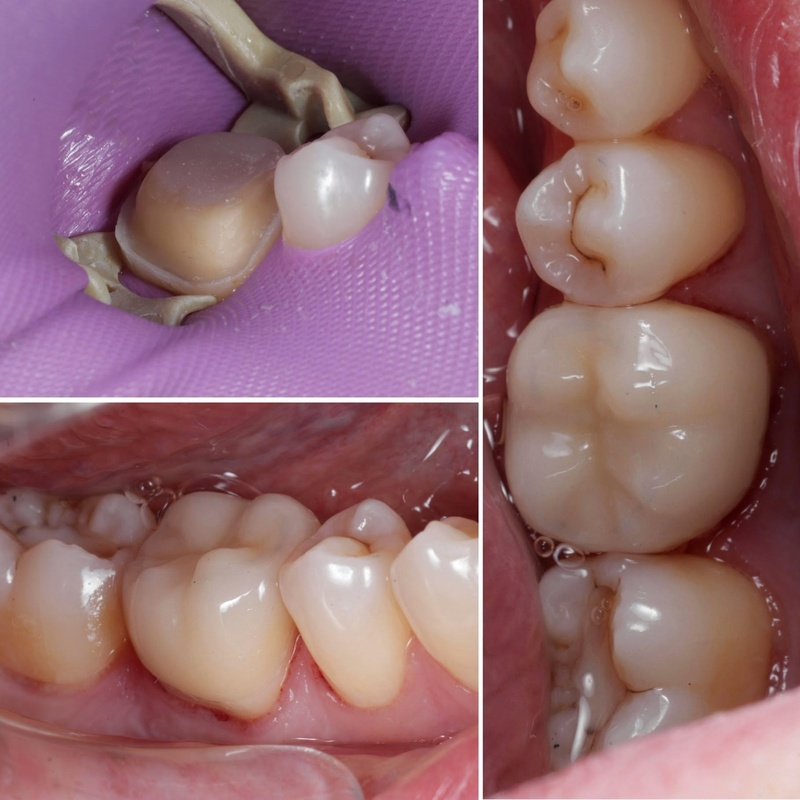 Bọc răng sứ áp dụng cho tình trạng răng gãy vỡ lớn