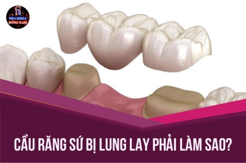 Cầu răng sứ bị lung lay phải làm sao?