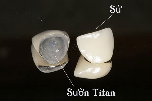 cấu tạo răng sứ titan