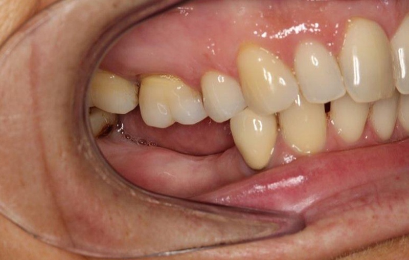 Mất răng số 7 lâu năm có thể gây tiêu xương hàm