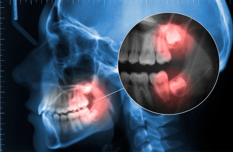 Mọc răng khôn thường gây nhiều đau nhức cho bệnh nhân