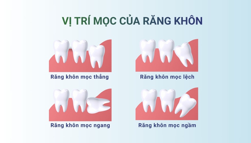 Một số trường hợp mọc răng khôn