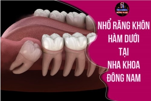Review nhổ răng khôn hàm dưới của bệnh nhân tại Nha khoa Đông Nam