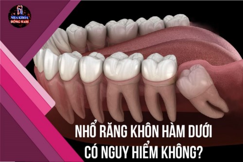 Nhổ răng khôn hàm dưới có nguy hiểm không?