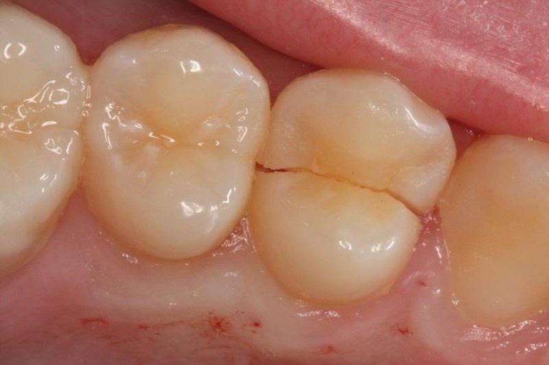 Răng có thể bị nứt gãy do gặp các ngoại lực mạnh từ bên ngoài