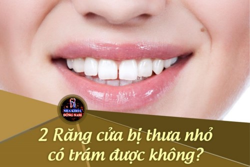 2 Răng cửa bị thưa nhỏ có trám được không?