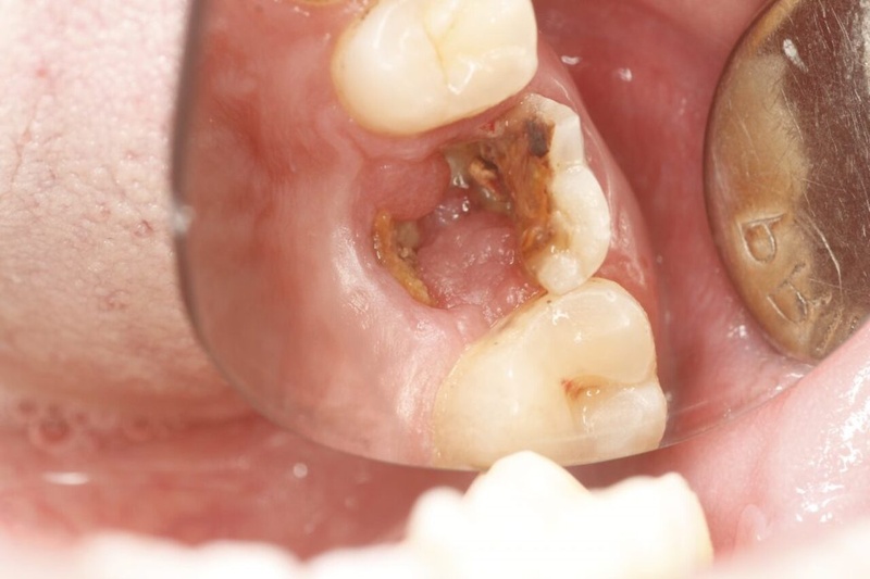 Răng hàm gãy vỡ do mắc bệnh lý sâu răng