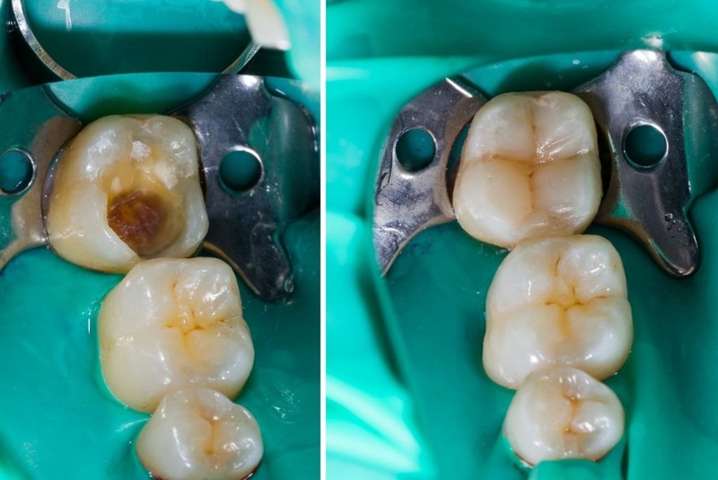 Trám răng thường áp dụng cho tình trạng răng số 6 bị sâu, gãy vỡ nhẹ