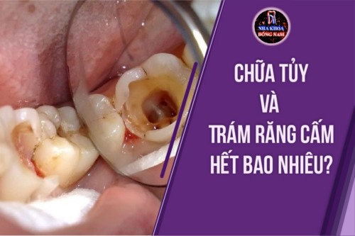 Trám răng và chữa tủy răng cấm hết bao nhiêu?