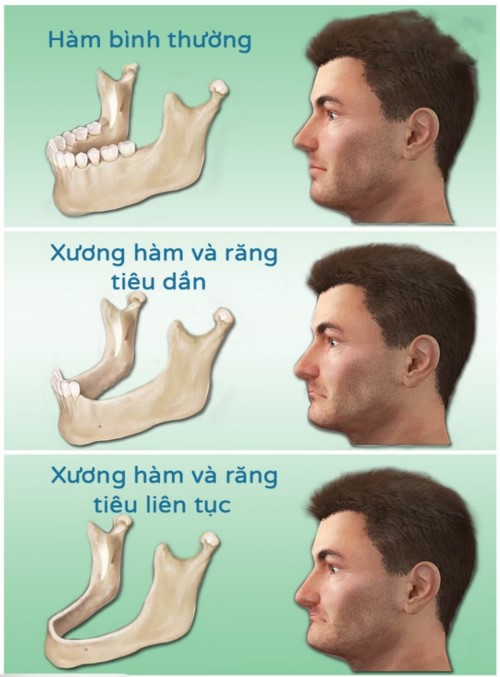 hiện tượng tiêu xương hàm