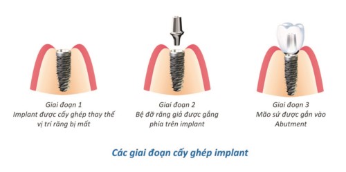 mô phỏng trồng răng implant