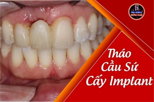 Tư vấn: Tháo cầu sứ cấy Implant