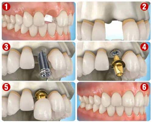 các bước trong quá trình trồng răng vĩnh viễn