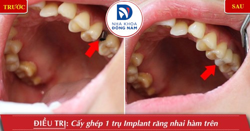 cấy 1 trụ implant răng nhai hàm trên