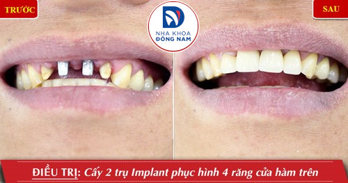 cấy implant 2 răng cửa