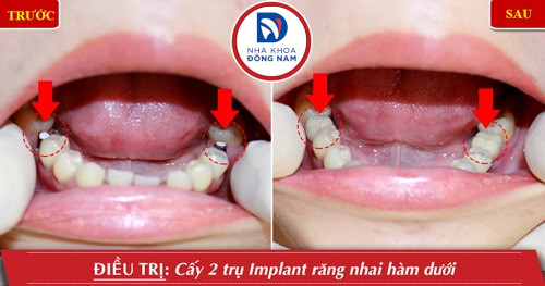 cấy 2 trụ implant răng nhai hàm dưới