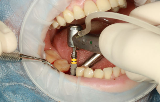 Đặt trụ Implant tức thì ngay tại thời điểm nhổ răng giúp rút ngắn thời gian điều trị