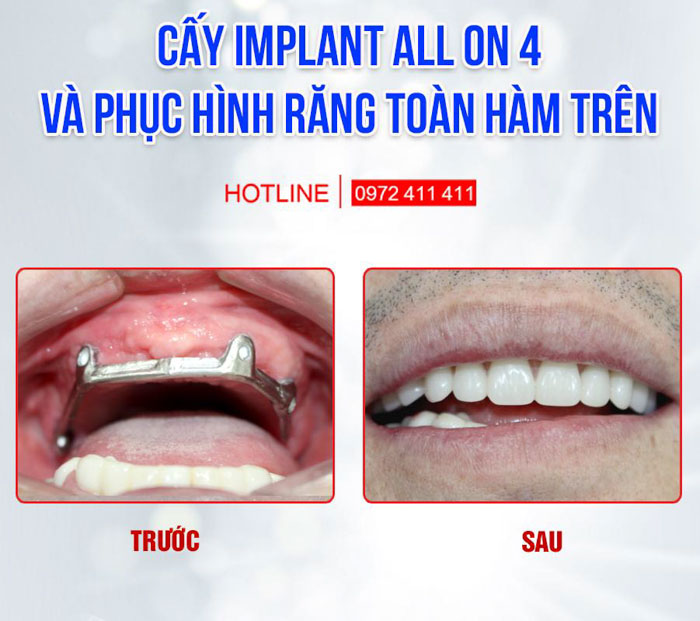 Implant All On 4 cho bệnh nhân mất răng toàn hàm tiêu xương nhiều